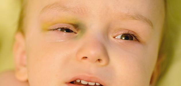 علاج الكدمات في الوجه للأطفال شقاوة