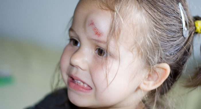 علاج الكدمات في الوجه للأطفال