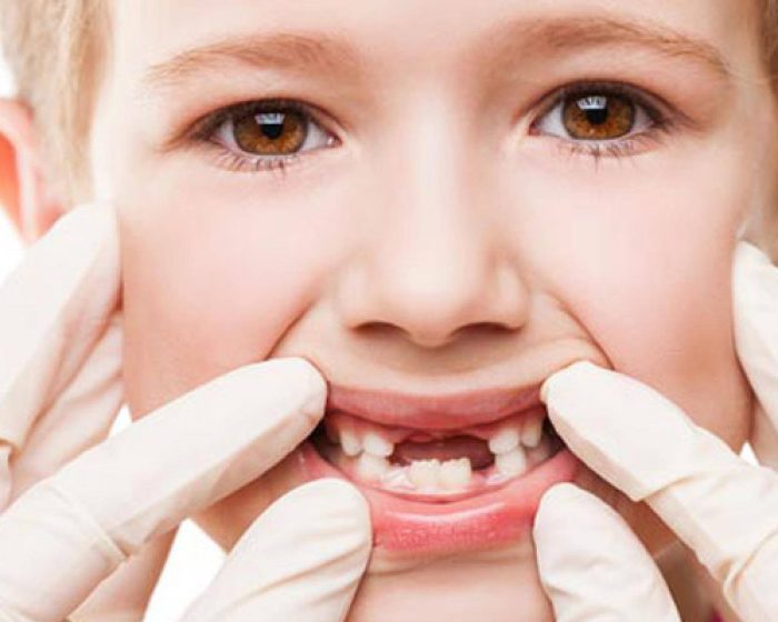 دواء مسكن ألم الأسنان للأطفال