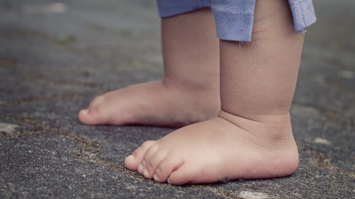 علاج تقوس الساقين للأطفال