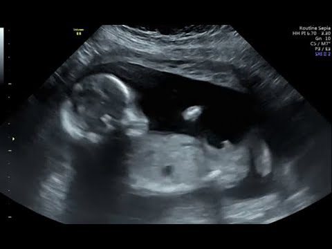 حركة الجنين في الشهر الثالث