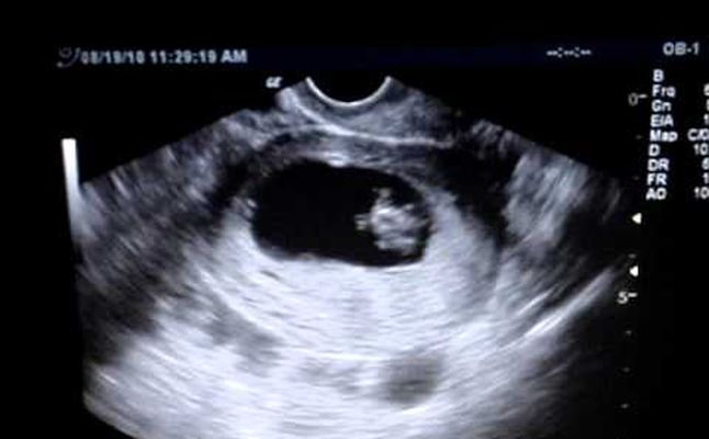 حركة الجنين في الشهر الأول