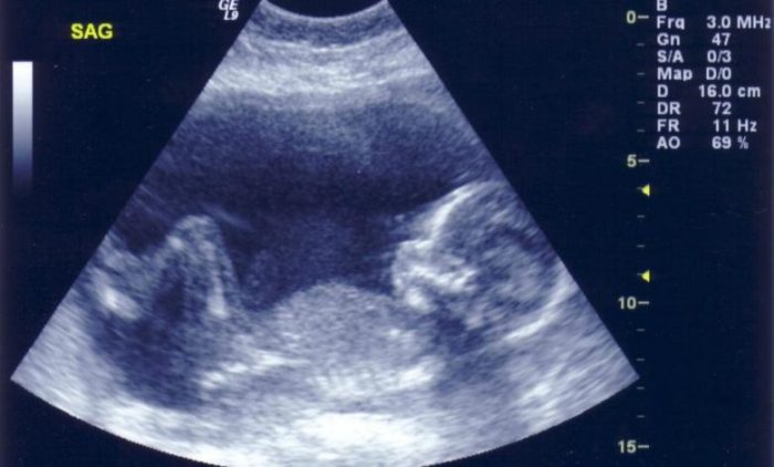 هل السونار يخطئ في تحديد نوع الجنين في الشهر الخامس
