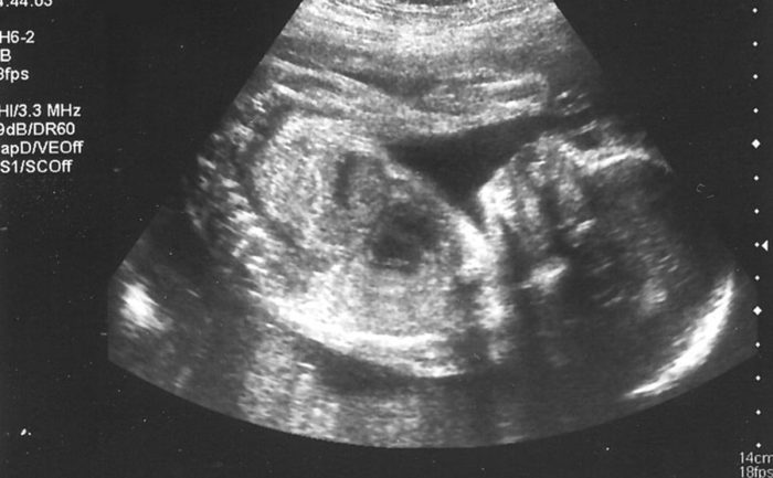 وضع الجنين في الشهر السادس داخل الرحم