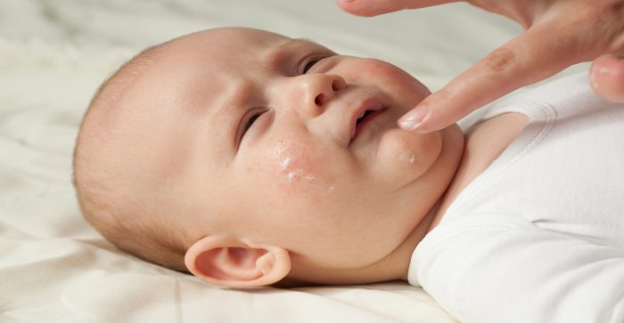 متى تظهر حساسية الحليب عند الرضع ومتى تختفي