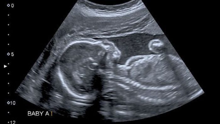 الشهر الثالث من الحمل وجنس الجنين