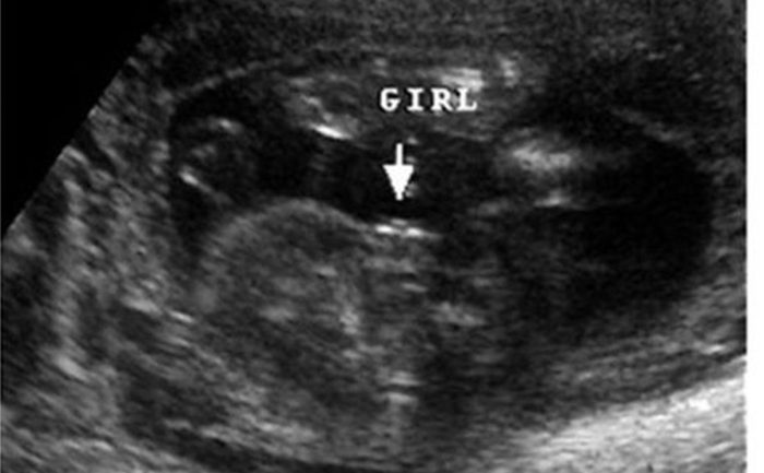هل يخطئ السونار في تحديد نوع الجنين في الشهر الرابع؟