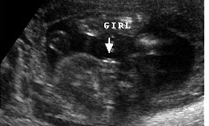 هل يخطئ السونار في تحديد نوع الجنين في الشهر التاسع