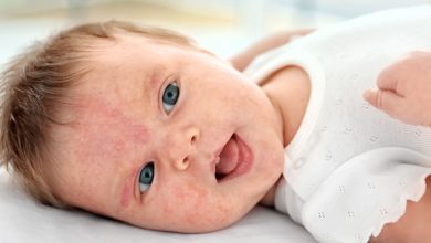 حساسية الحليب عند الرضع.. الأسباب والأعراض والعلاج