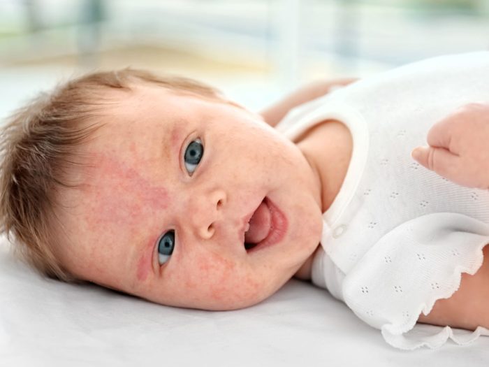 حساسية الحليب عند الرضع.. الأسباب والأعراض والعلاج