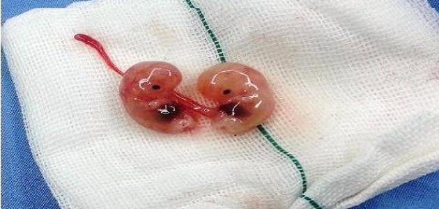 شكل كيس الحمل بعد الإجهاض بالصور