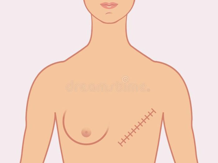 أعراض سرطان الثدي بالصور الحقيقية