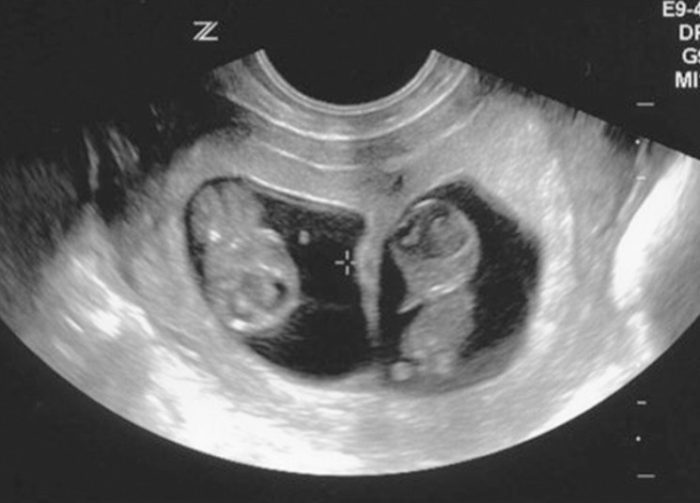 مراحل نمو الجنين التوأم بالأسابيع بالصور