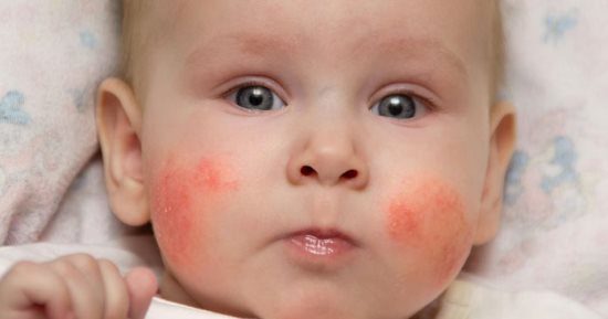 أسباب ظهور بقع حمراء في فروة رأس الرضيع