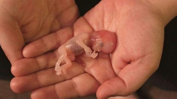 تفسير حلم الإجهاض للحامل