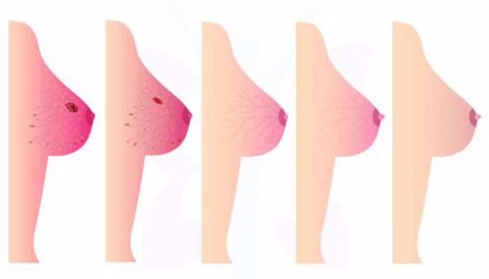 شكل الطفح الجلدي لسرطان الثدي بالصور