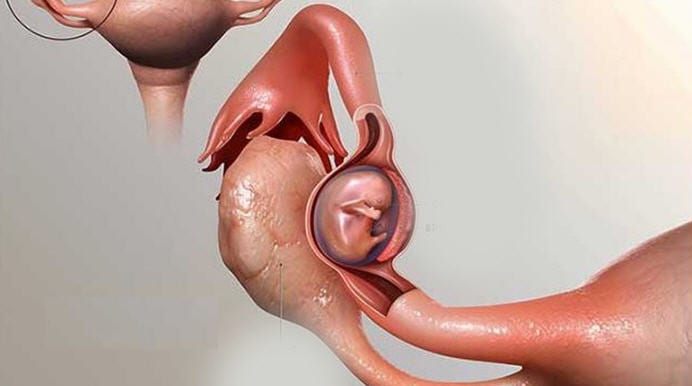الحمل خارج الرحم هل يستمر