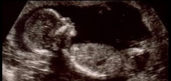 علامات الحمل ببنت أو ولد من الشهر الأول